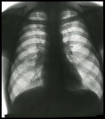 Document médical, radiographie de poumons non identifiés.
